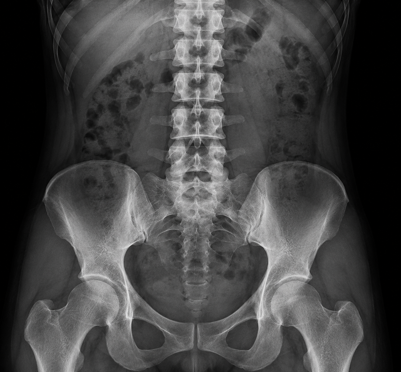 AP lumbar spine X-ray.