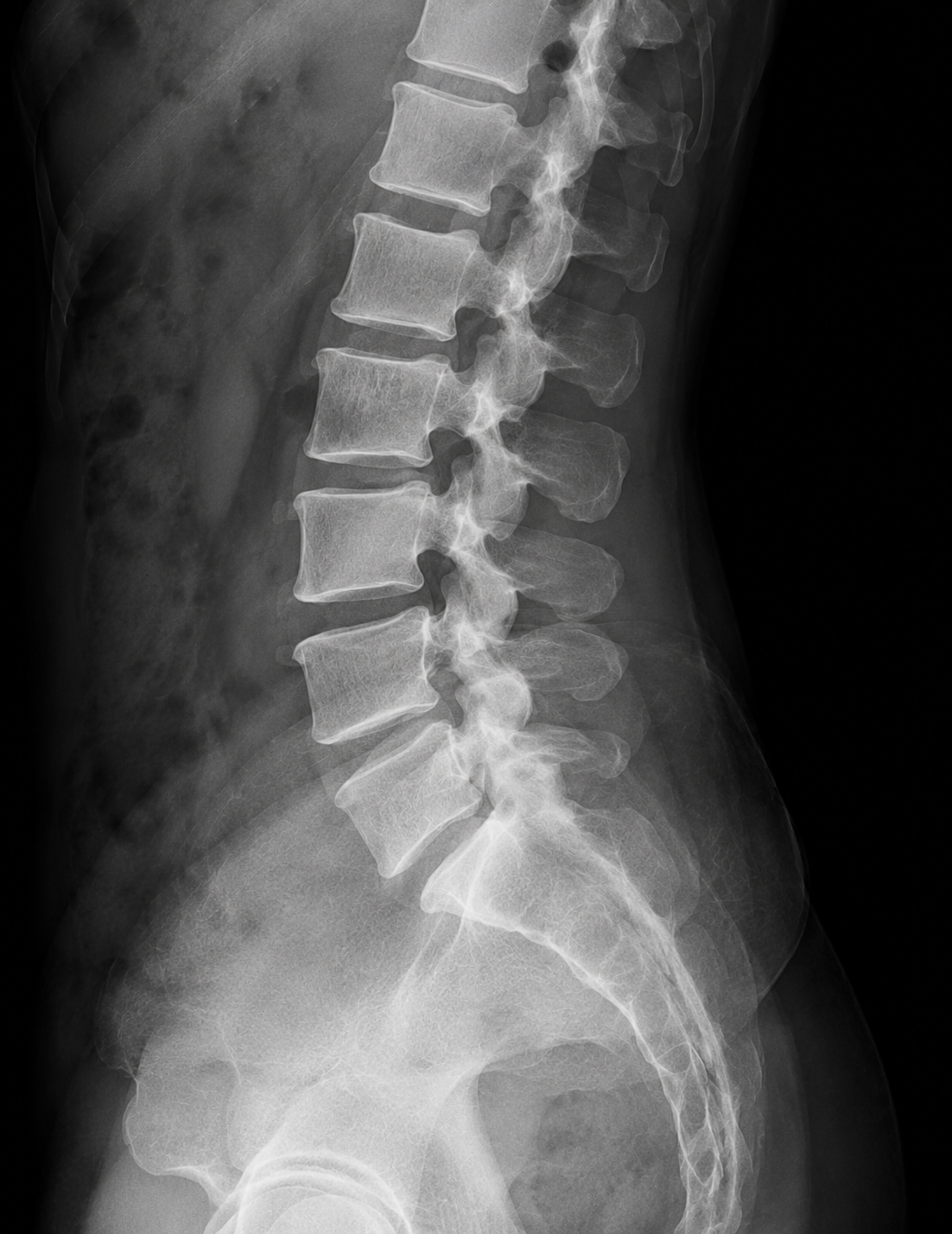 Digital lumbar X-ray used when clinically appropriate during low back pain evaluation.